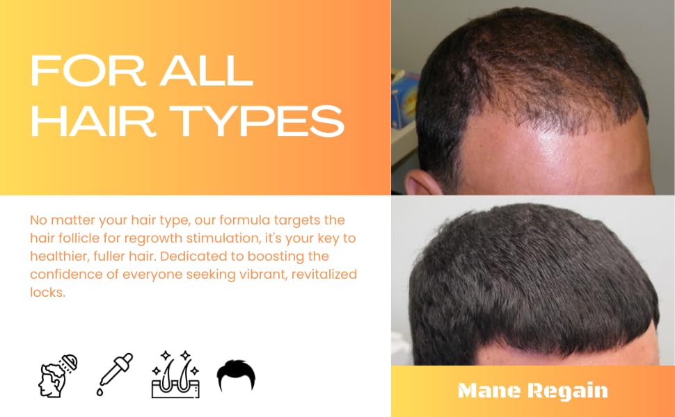 Minoxidil Topical Solution USP 5%, Extra Strength Hair Regrowth Treatment for Men, 1 Month Supply, Unscented, 2 Fl Oz (1 Pack)