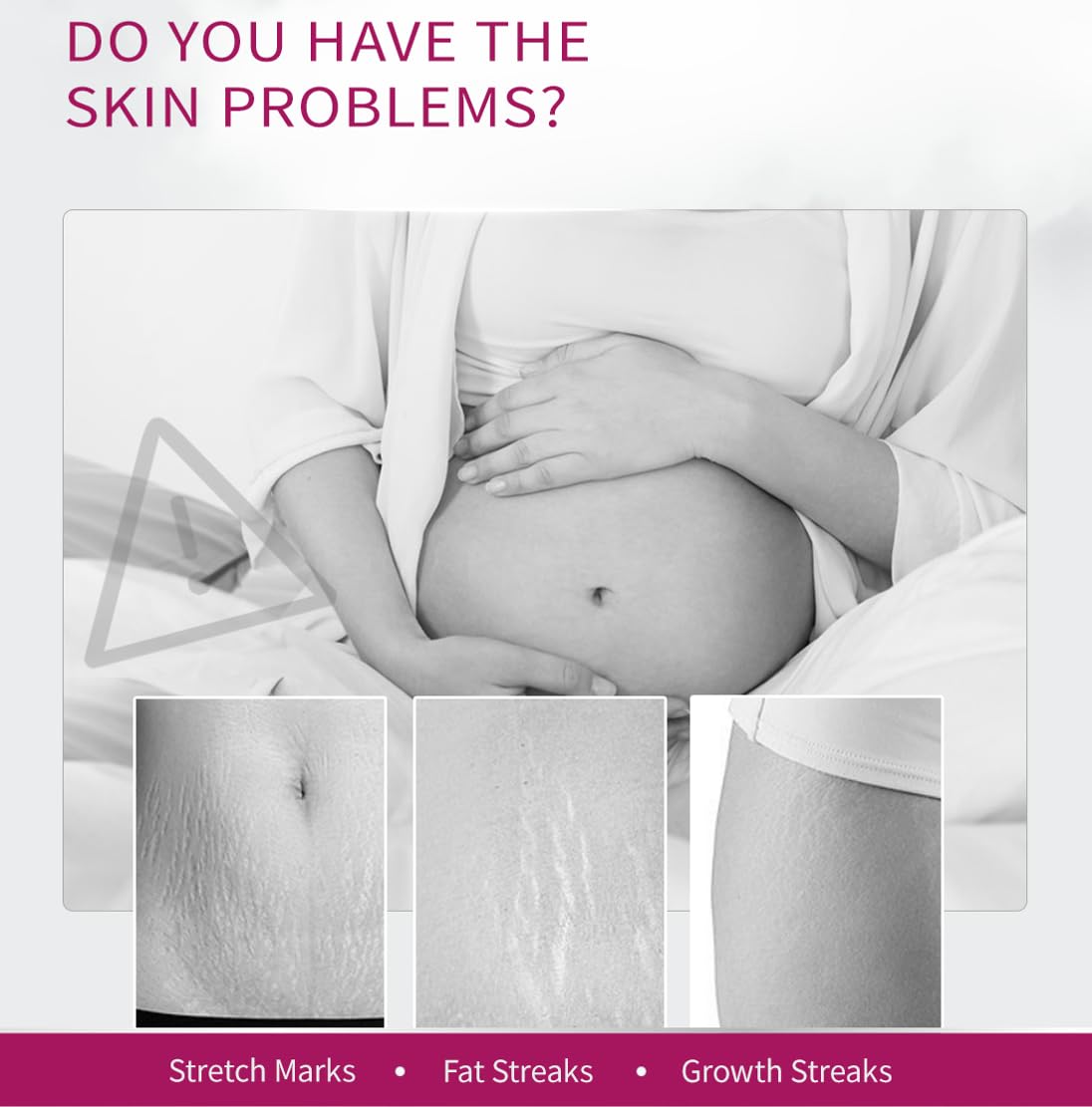 Stretch Mark Removal Cream, Obesity Stretch Mark Moisturizer, Postpartum Repair Stretch Mark Cream, Abdominal Stretch Mark Cream, Remove Marks (2 PCS)