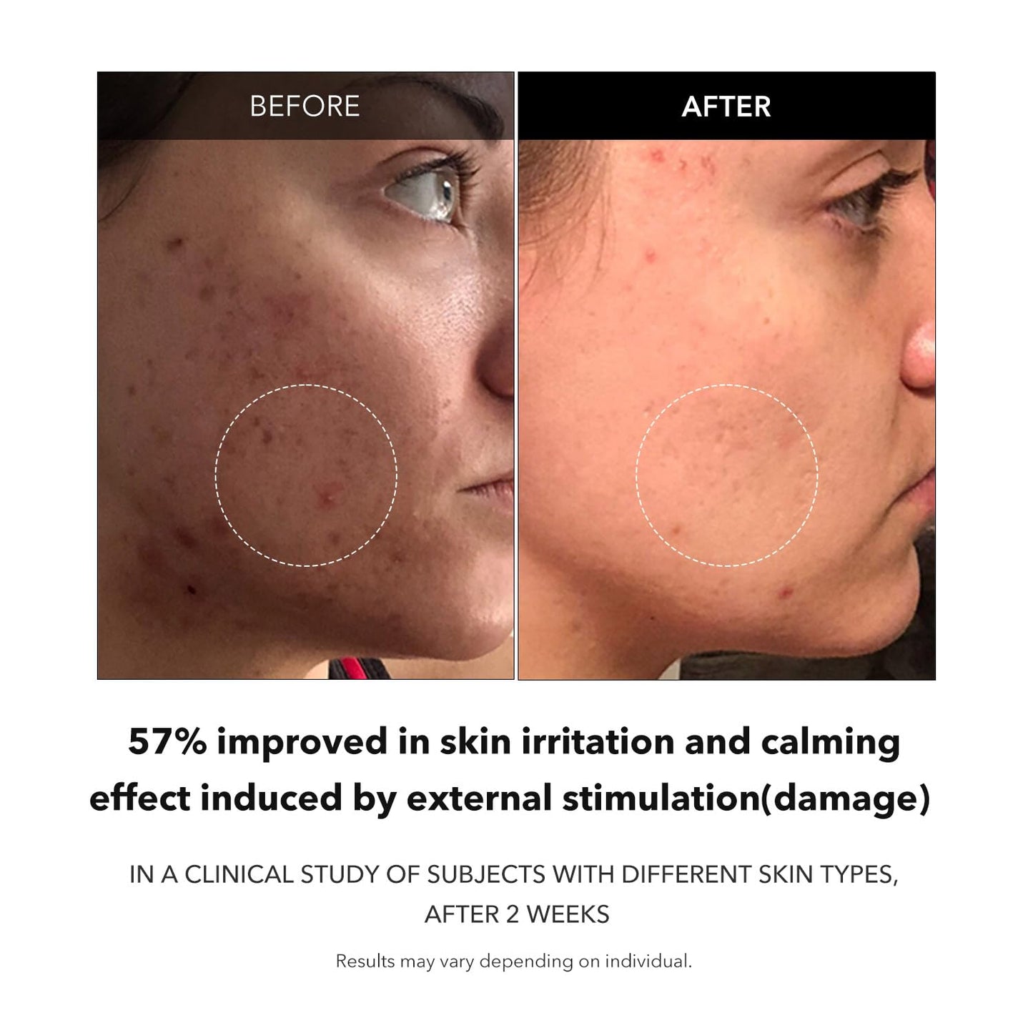 APRILSKIN Carrotene Clarifying Facial Serum | Vegan, Non-comedogenic | Blemish Clear, Dark Spot Corrector | Korea Skincare | Oily Skin, Sensitive Skin, Bumpy Skin | 1.25 fl.oz