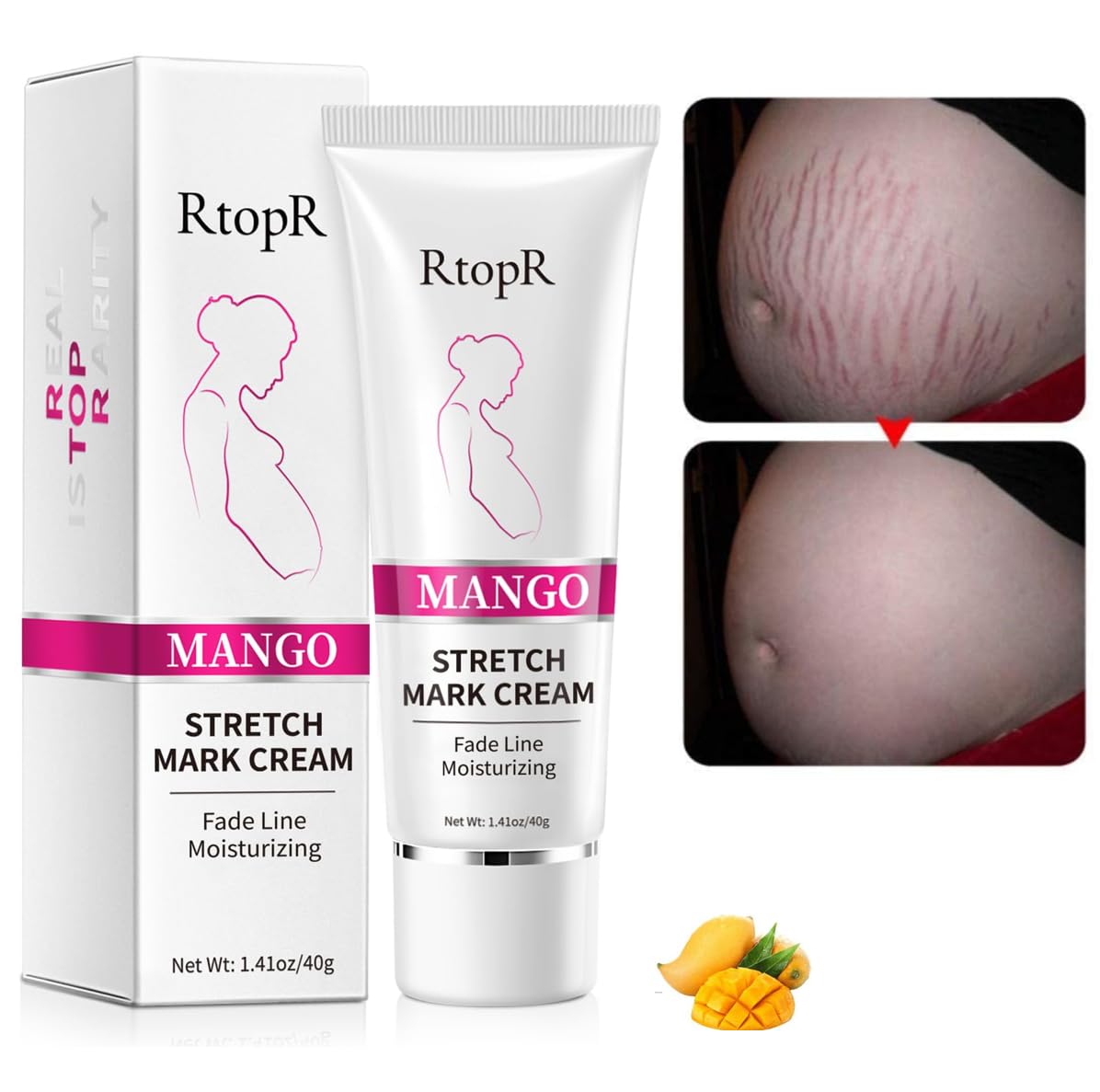 Stretch Mark Removal Cream, Obesity Stretch Mark Moisturizer, Postpartum Repair Stretch Mark Cream, Abdominal Stretch Mark Cream, Remove Marks (2 PCS)