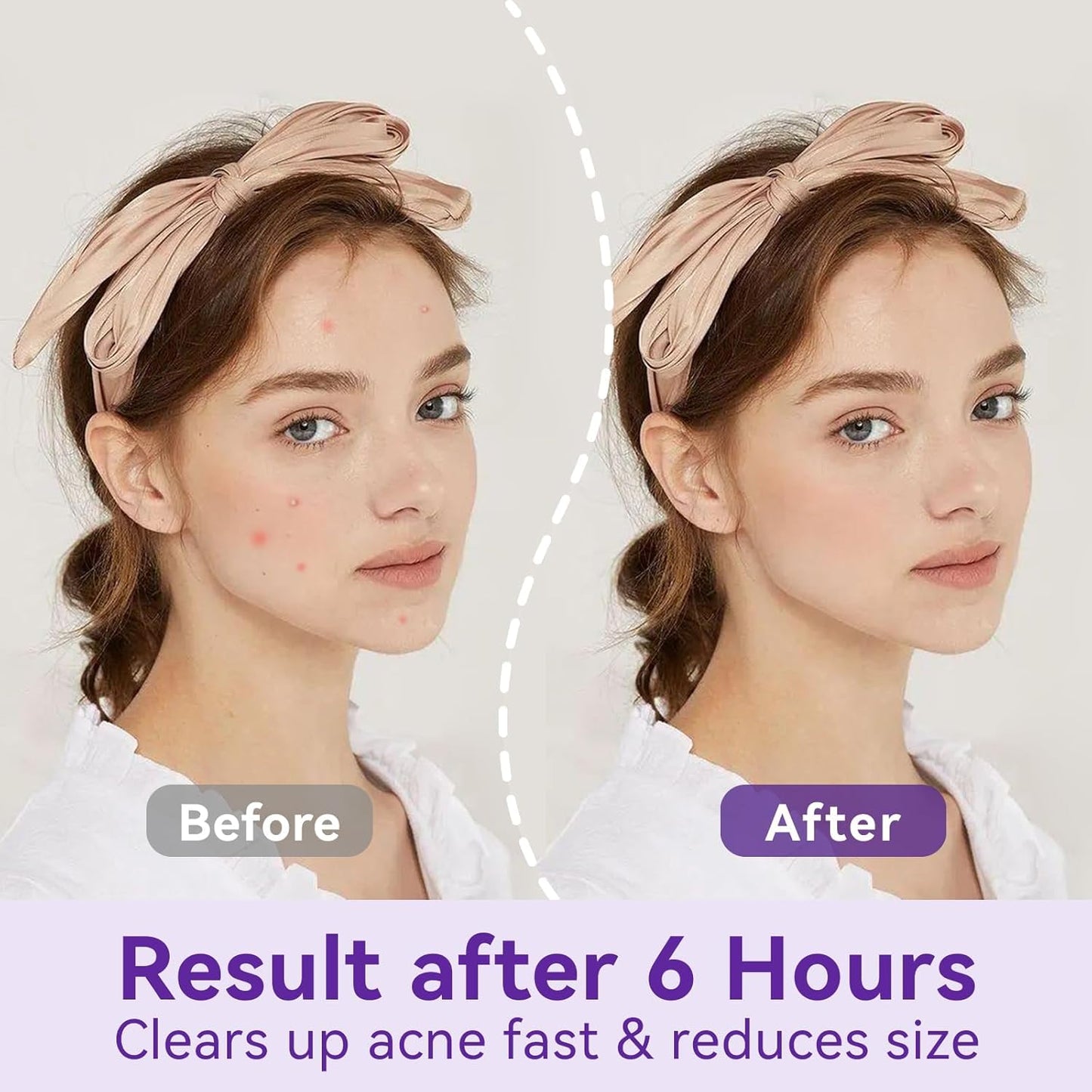 Overnight Pimple Patches for Face - Maximum Strength Hydrocolloid for Cystic Acne & Dark Spots (72 Count) - 10mm & 12mm Medicated Night Time Treatment