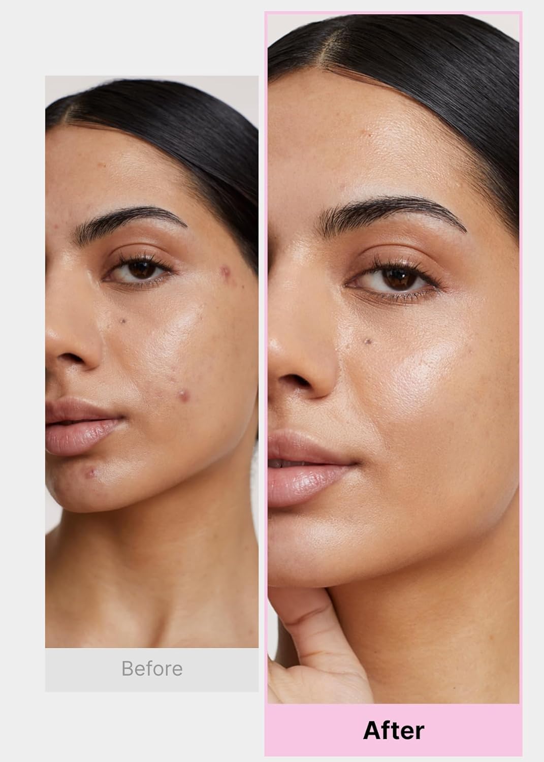 EasyDerm Multi-Step Pimple Patch Set – 4-Type Korean Pimple Patches + Free 2-in-1 Dual-Tip Extractor for Complete Skincare