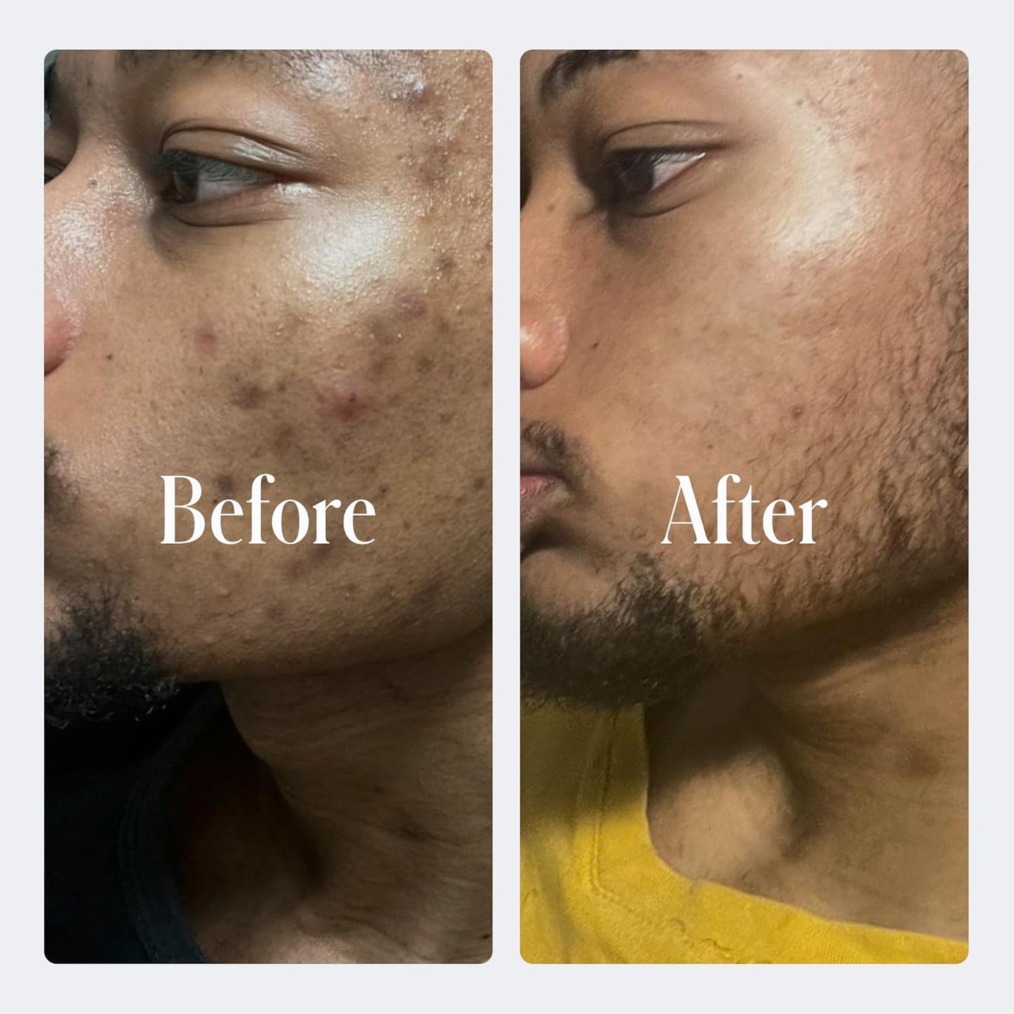 Geologie Clear System | 3-Step Acne Treatment & Skincare Set | Clears Skin Fast | Acne Gel Cleanser, SPF15 Day Cream & Retinol Face Cream For Men & Women | Month 1 / Level 1