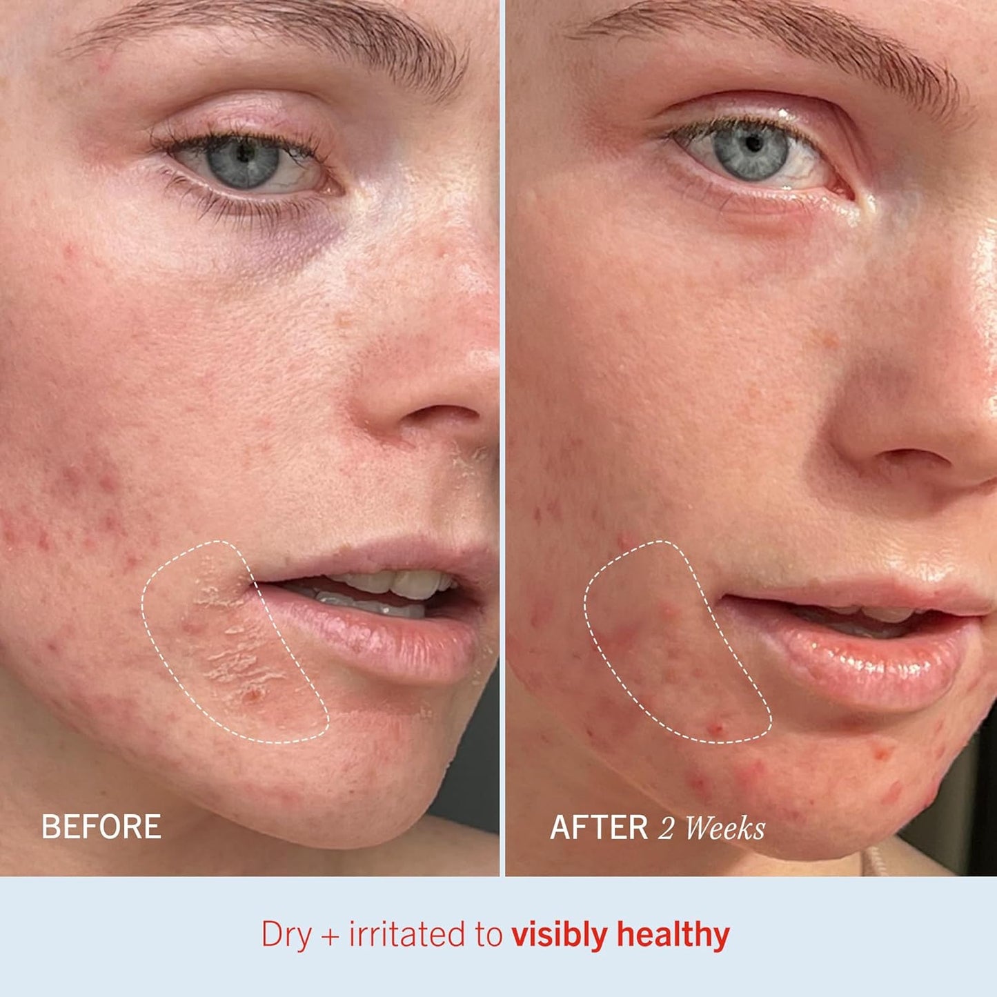 First Aid Beauty - Ultra Repair Cream, Intense Hydration Whipped Colloidal Oatmeal, Clinically Proven to Strengthen Skin Barrier in 7 Days & Helps Relieve Eczema, Luxury Moisturizer, 6 oz + Bonus, 2ct