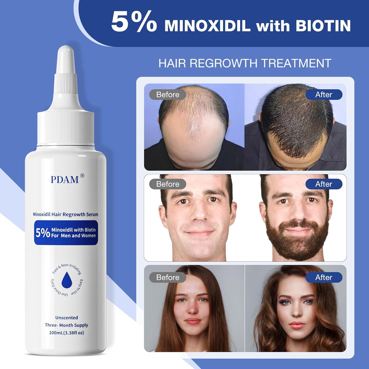 5% Minoxidil for Men Hair Growth Serum - Minoxidil for Women Serum with Biotin for Thicker & Healthier, Topical Minoxidil for Men Restore Fuller Beard